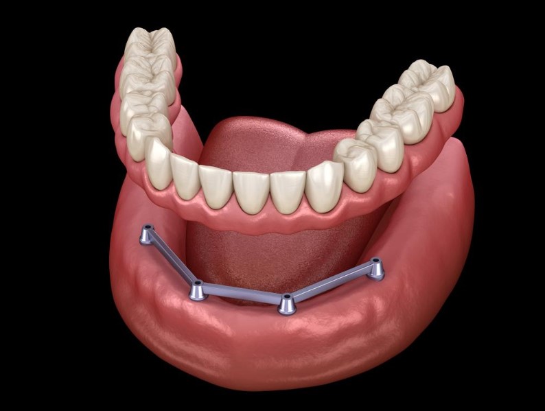 all on 4 dental implants
