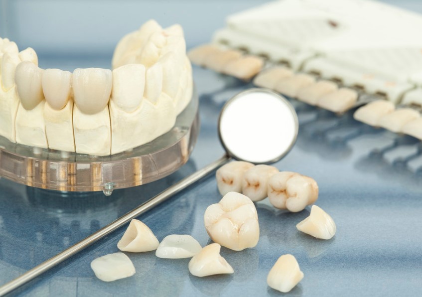 full mouth dental implant